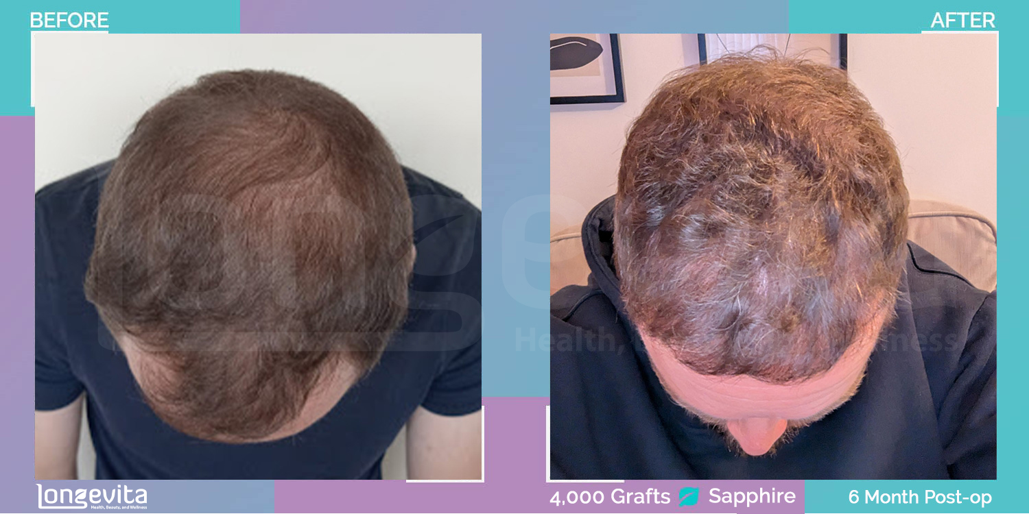 SAPPHIRE hair transplant before and after, 4000 grafts, 4 zones covered, 30s male patient