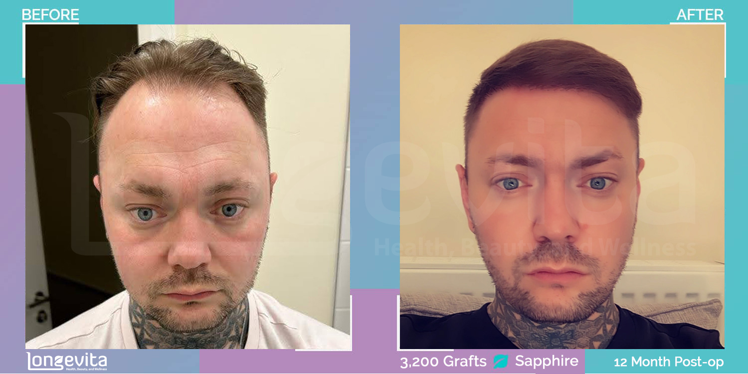 SAPPHIRE hair transplant before and after, 3200 grafts, 3 zones covered, 30s male patient