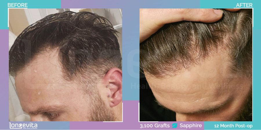 SAPPHIRE hair transplant before and after, 3100 grafts, 2 zones covered, 30s male patient