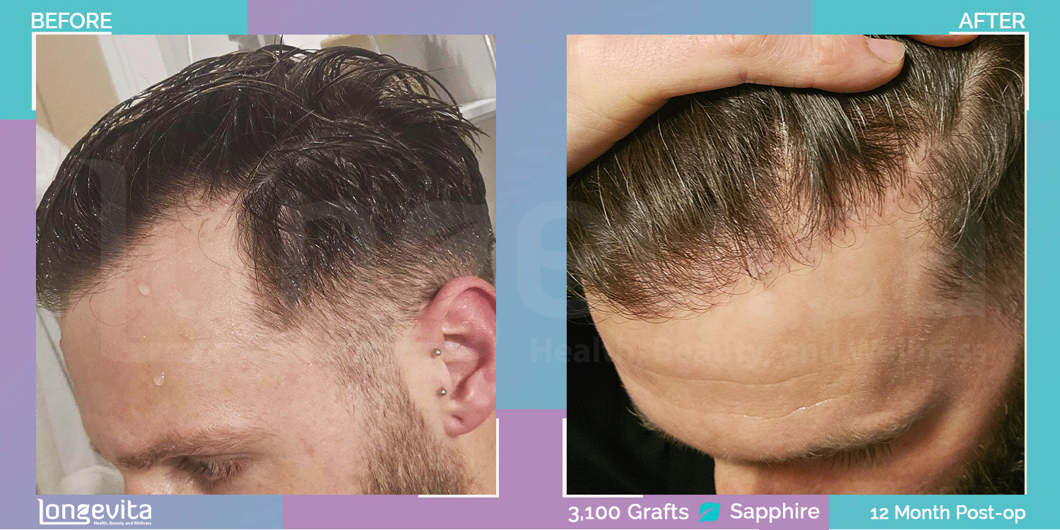 SAPPHIRE hair transplant before and after, 3100 grafts, 2 zones covered, 30s male patient