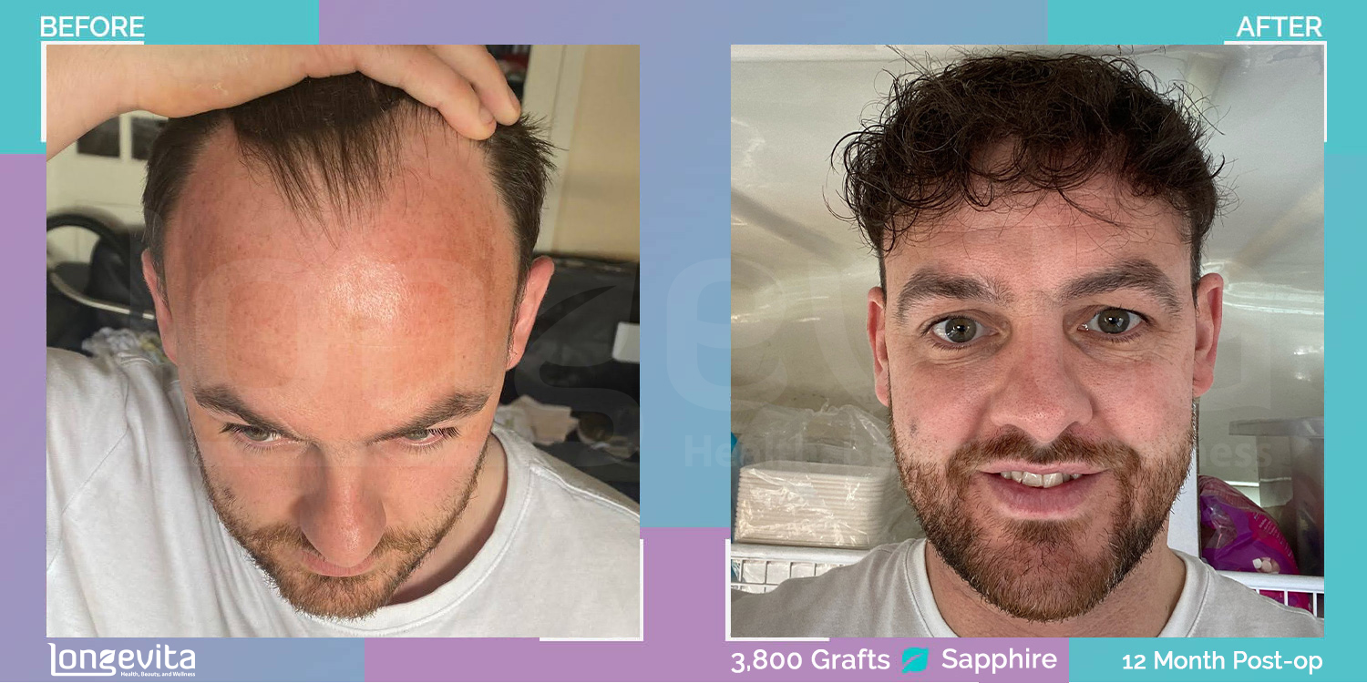 SAPPHIRE hair transplant before and after, 3800 grafts, 4 zones covered, 30s male patient