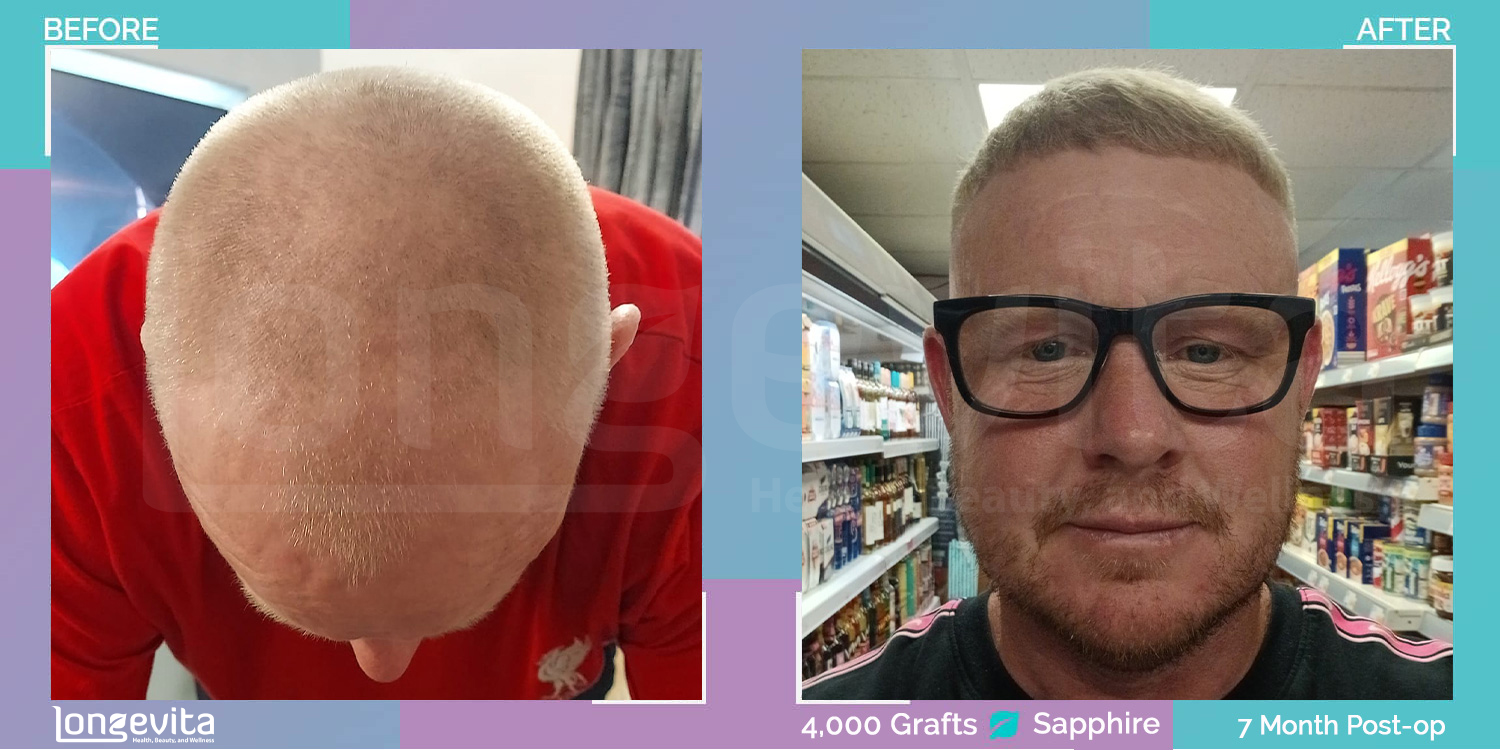 SAPPHIRE hair transplant before and after, 4000 grafts, 3 zones covered, 40s male patient