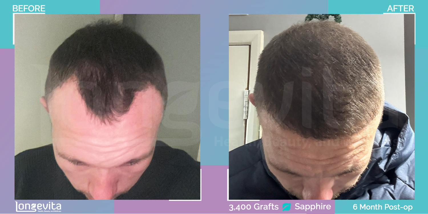 SAPPHIRE hair transplant before and after, 3400 grafts, 3 zones covered, 30s male patient