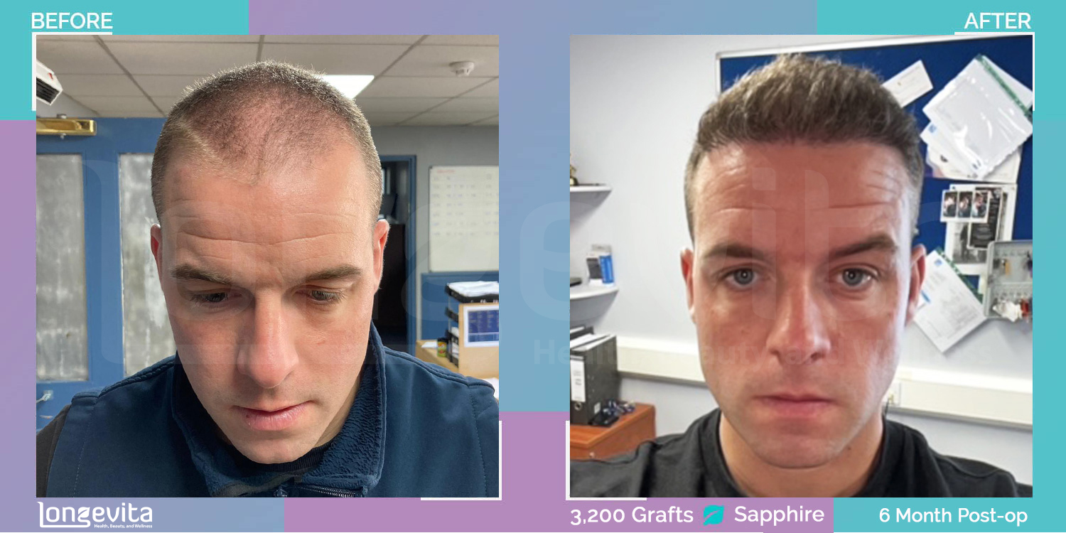 SAPPHIRE hair transplant before and after, 3200 grafts, 4 zones covered, 30s male patient