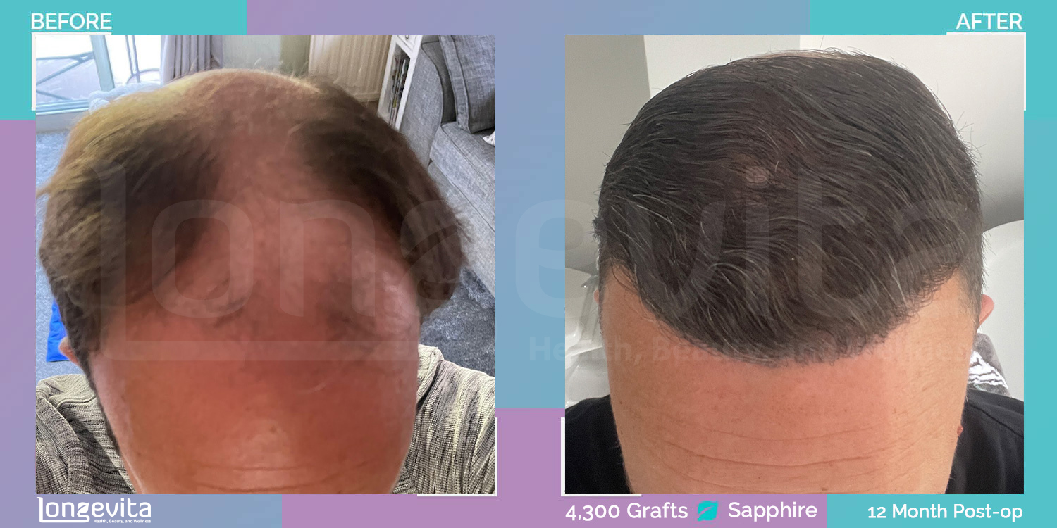 SAPPHIRE hair transplant before and after, 4300 grafts, 3 zones covered, 40s male patient