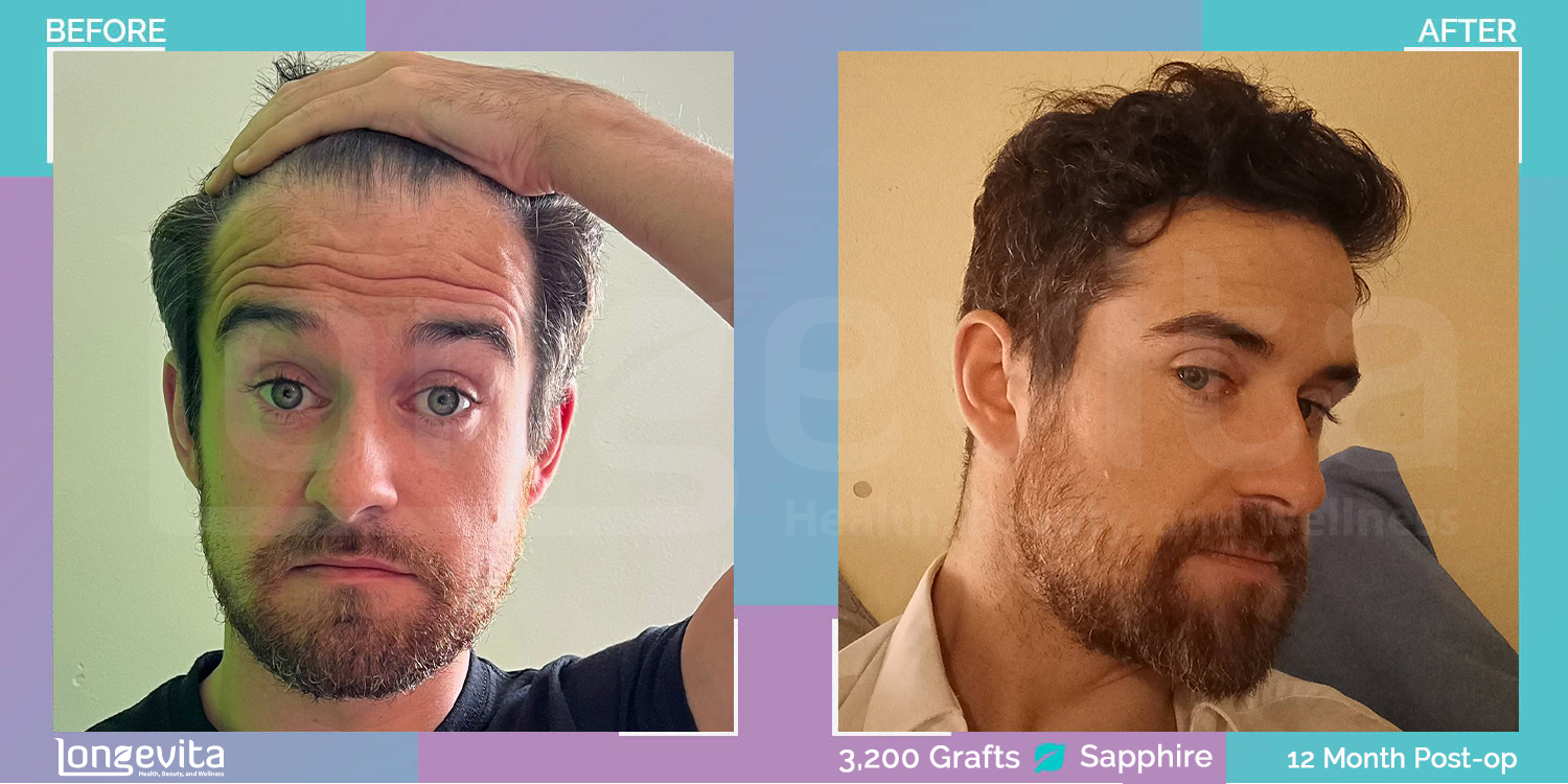 SAPPHIRE hair transplant before and after, 3200 grafts, 3 zones covered, 30s male patient
