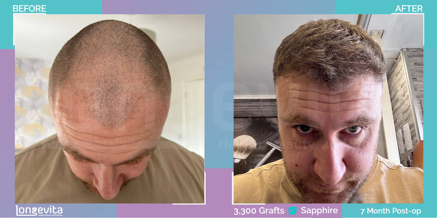 SAPPHIRE hair transplant before and after, 3300 grafts, 5 zones covered, 30s male patient