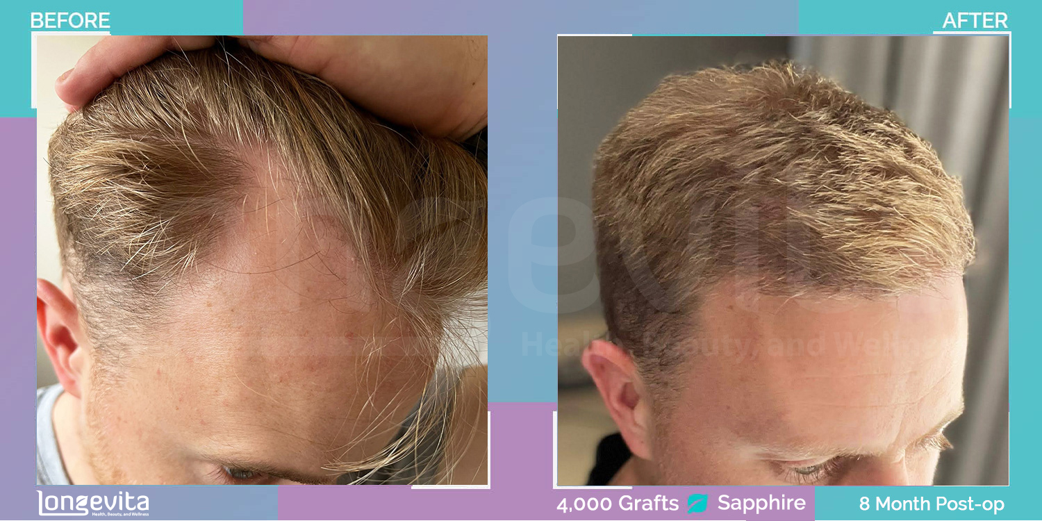 SAPPHIRE hair transplant before and after, 4000 grafts, 4 zones covered, 30s male patient