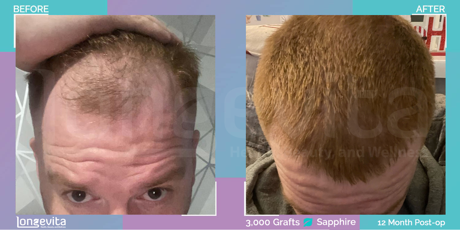 SAPPHIRE hair transplant before and after, 3000 grafts, 2 zones covered, 20s male patient