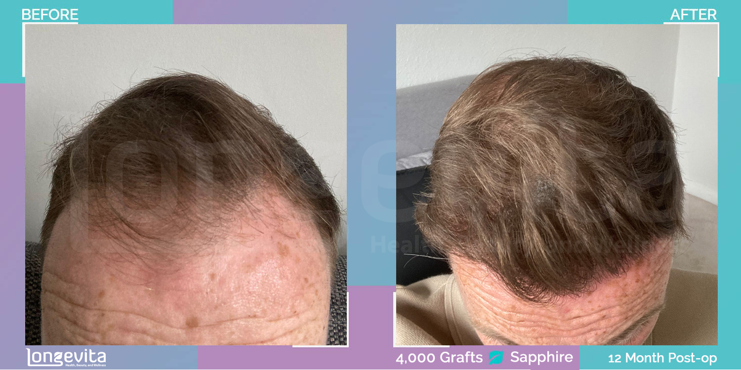 SAPPHIRE hair transplant before and after, 4000 grafts, 3 zones covered, 30s male patient