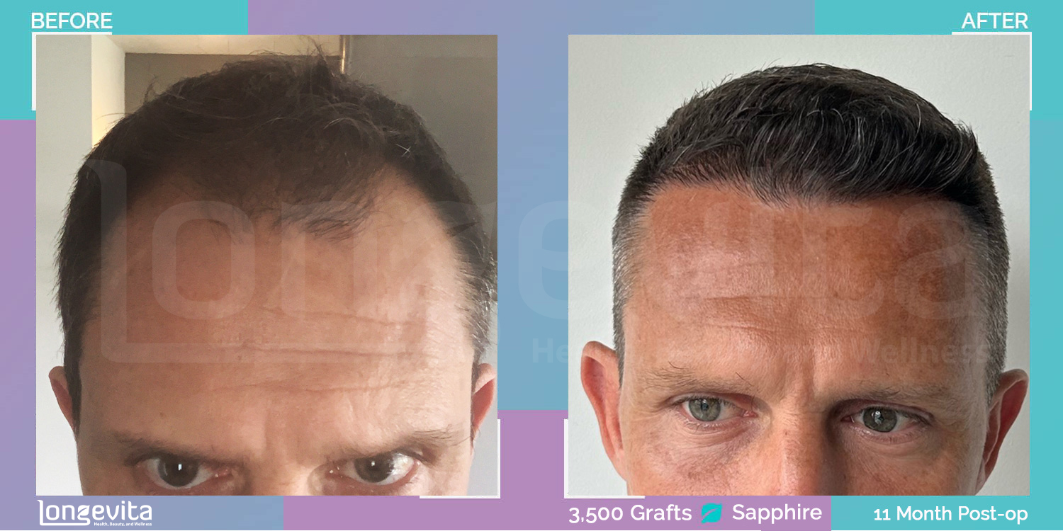 SAPPHIRE hair transplant before and after, 3500 grafts, 2 zones covered, 40s male patient