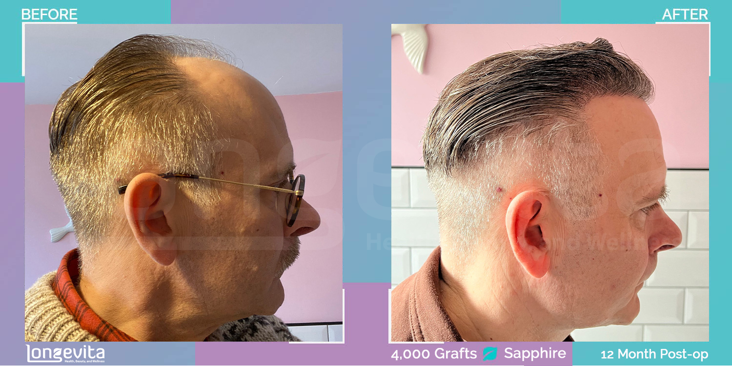 SAPPHIRE hair transplant before and after, 4000 grafts, 4 zones covered, 50s male patient