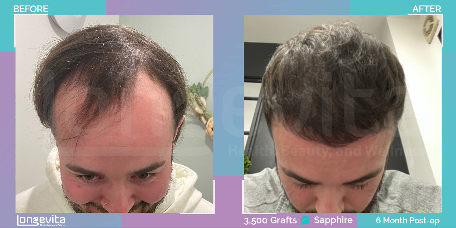 SAPPHIRE hair transplant before and after, 3500 grafts, 2 zones covered, 20s male patient