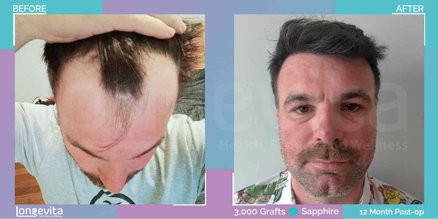 SAPPHIRE hair transplant before and after, 3000 grafts, 2 zones covered, 30s male patient