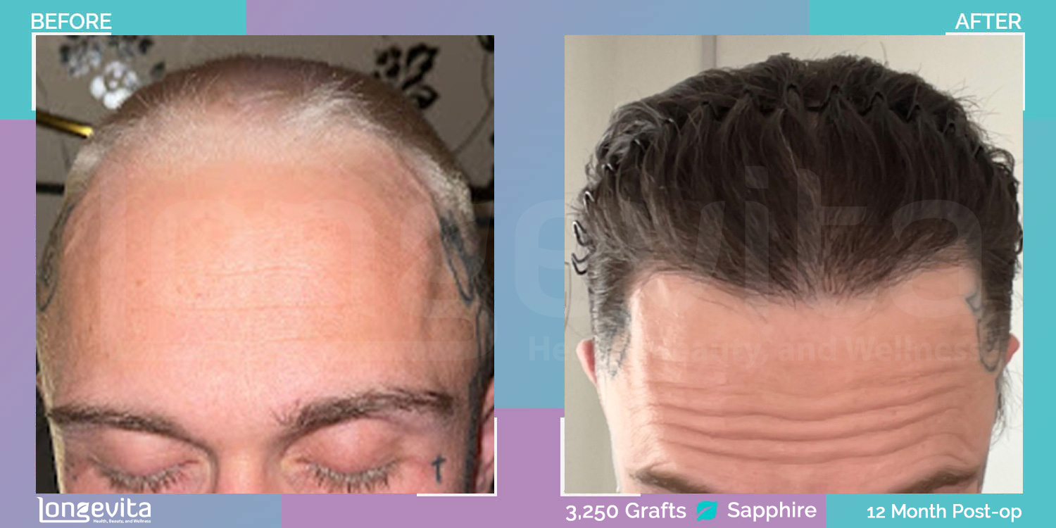 SAPPHIRE hair transplant before and after, 3250 grafts, 3 zones covered, 30s male patient