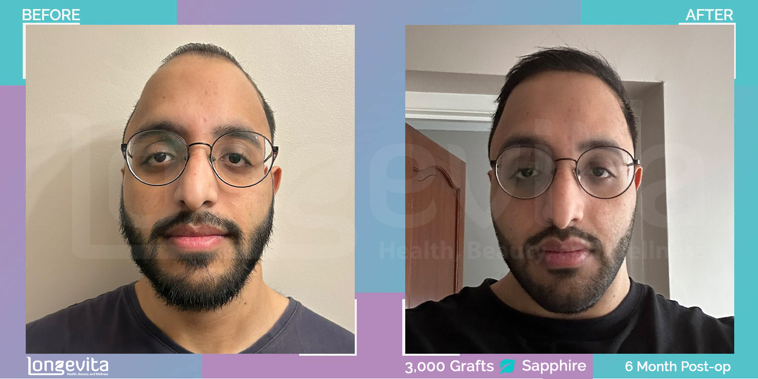 SAPPHIRE hair transplant before and after, 3000 grafts, 2 zones covered