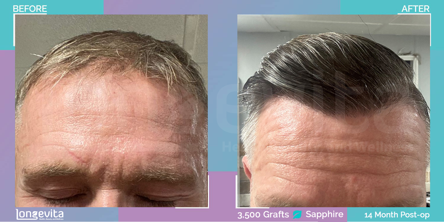SAPPHIRE hair transplant before and after, 3500 grafts, 3 zones covered, 40s male patient
