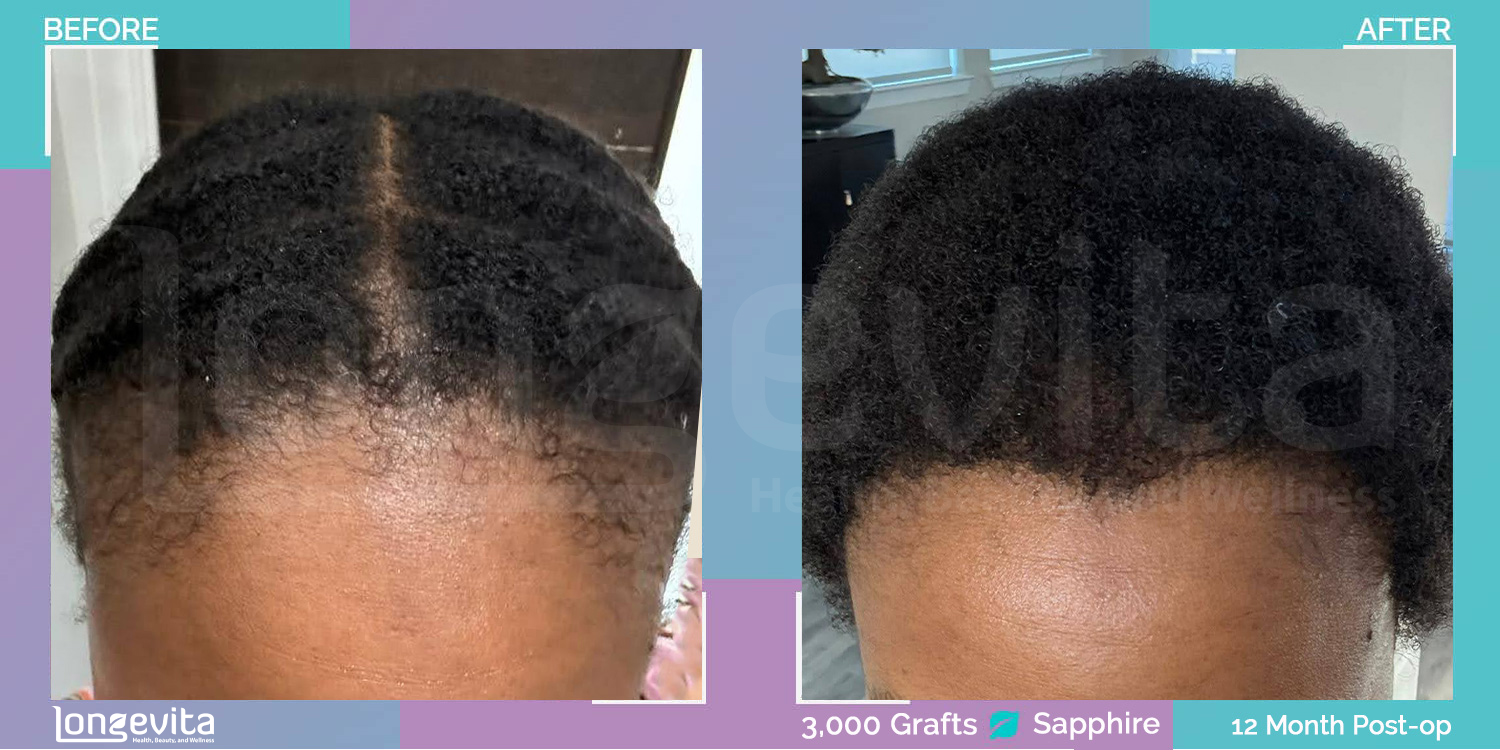 SAPPHIRE hair transplant before and after, 3000 grafts, 2 zones covered, 30s female patient