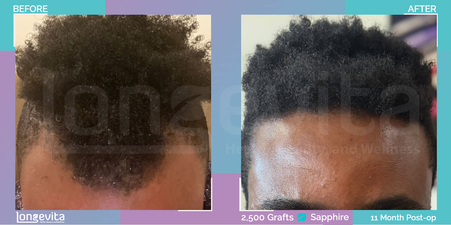 SAPPHIRE hair transplant before and after, 2500 grafts, 2 zones covered, 20s male patient