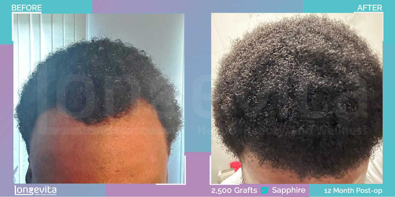 SAPPHIRE hair transplant before and after, 2500 grafts, 2 zones covered, 20s male patient