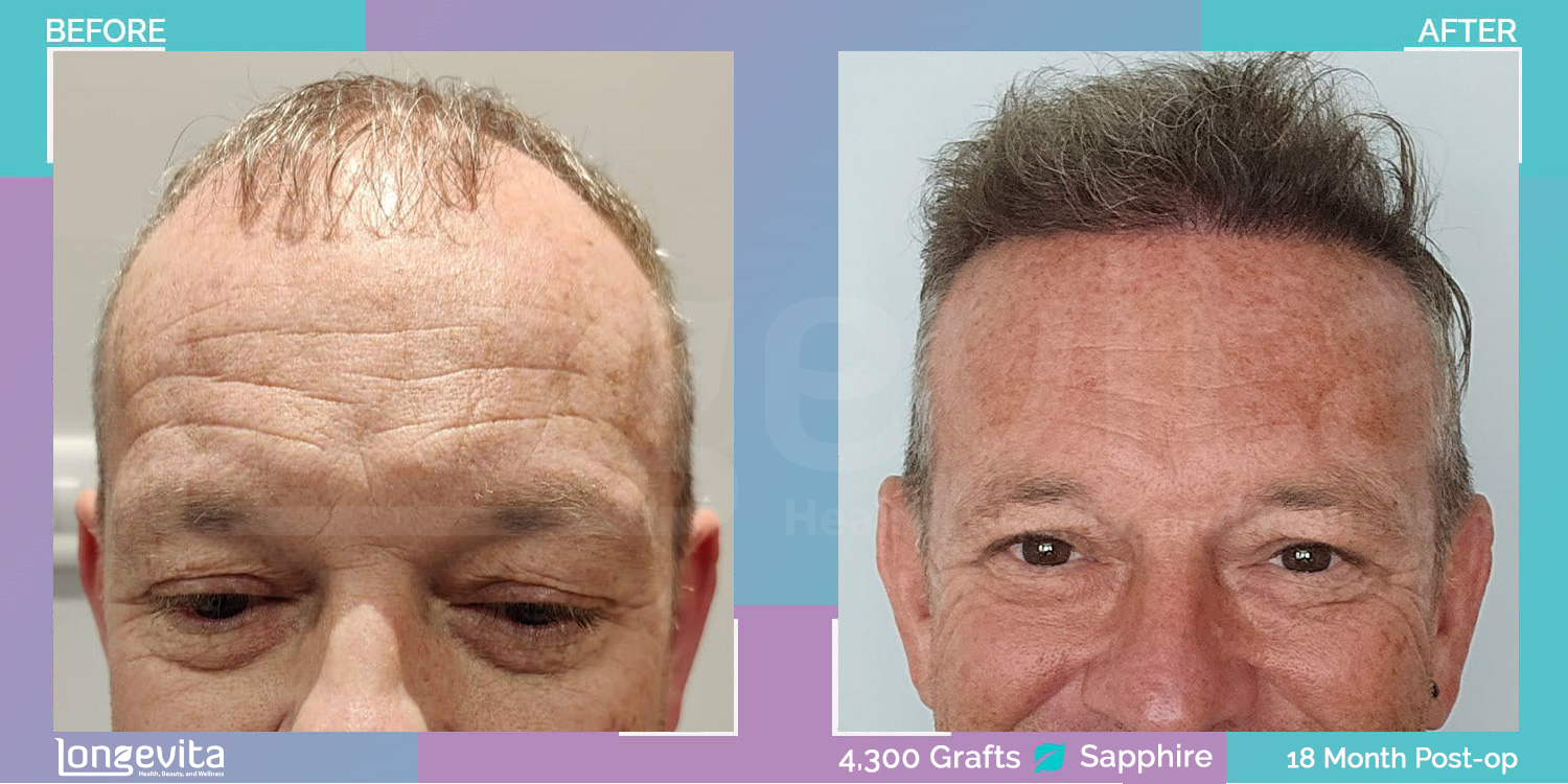 SAPPHIRE hair transplant before and after, 4300 grafts, 3 zones covered, 50s male patient
