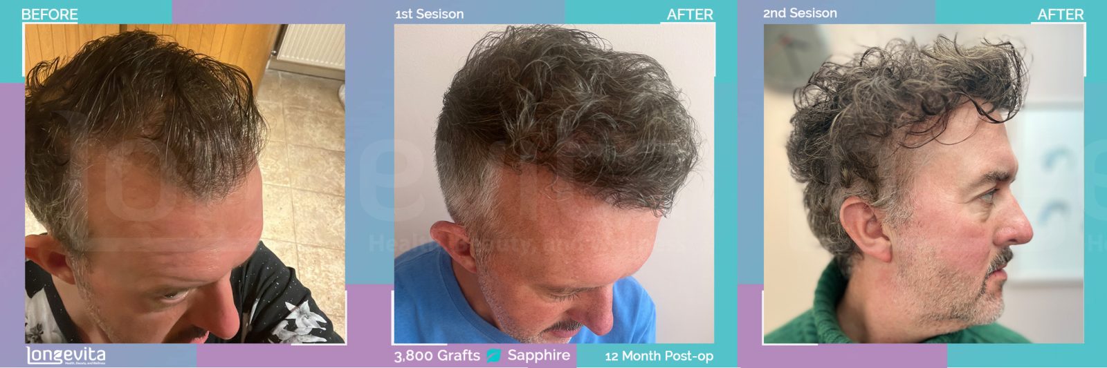 SAPPHIRE hair transplant before and after, 3800 grafts, 6 zones covered, 40s male patient
