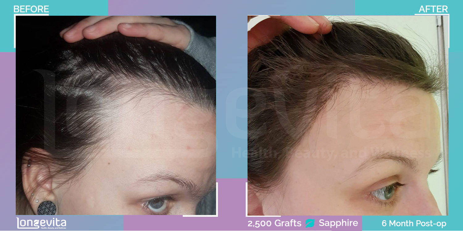 SAPPHIRE hair transplant before and after, 2500 grafts, 2 zones covered, 20s female patient