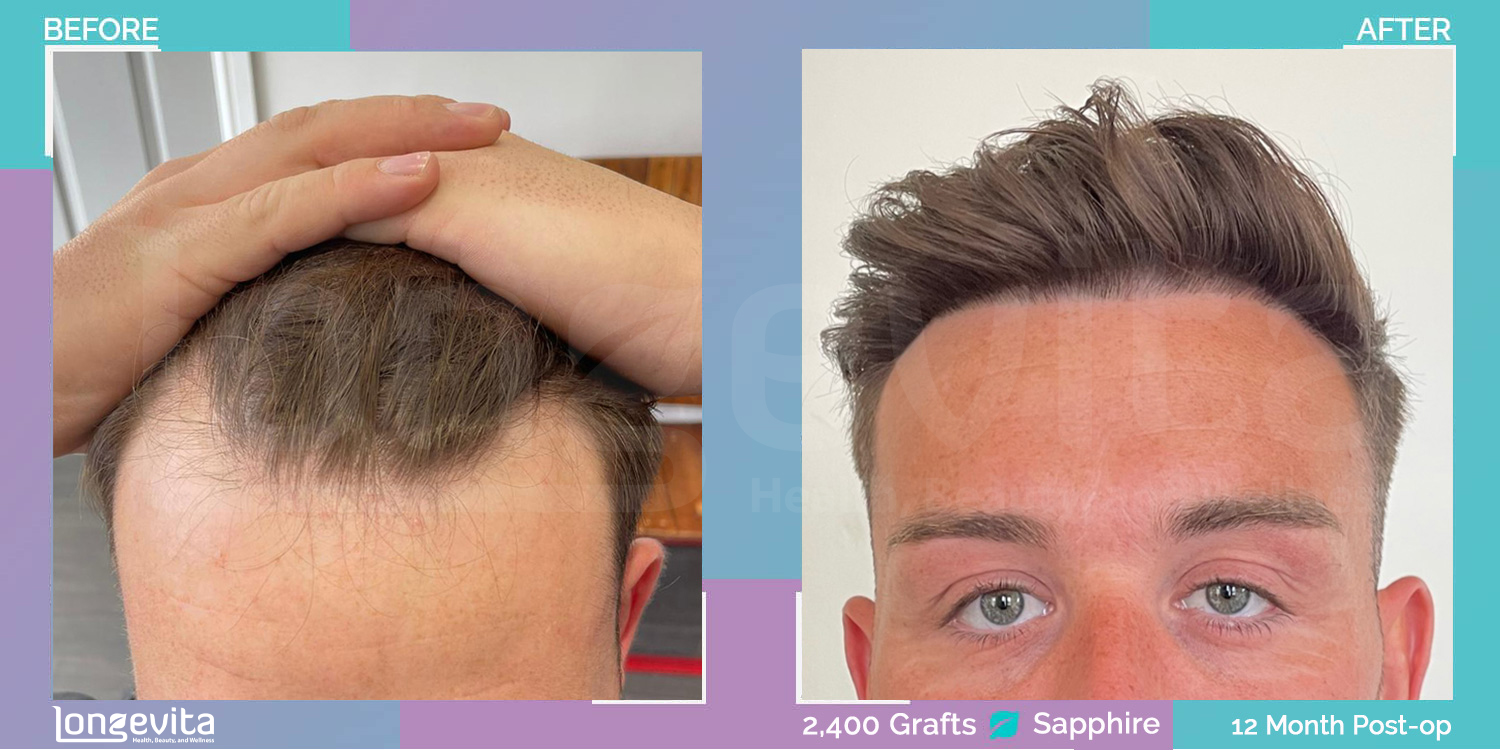 SAPPHIRE hair transplant before and after, 2400 grafts, 1 zone covered, 30s male patient