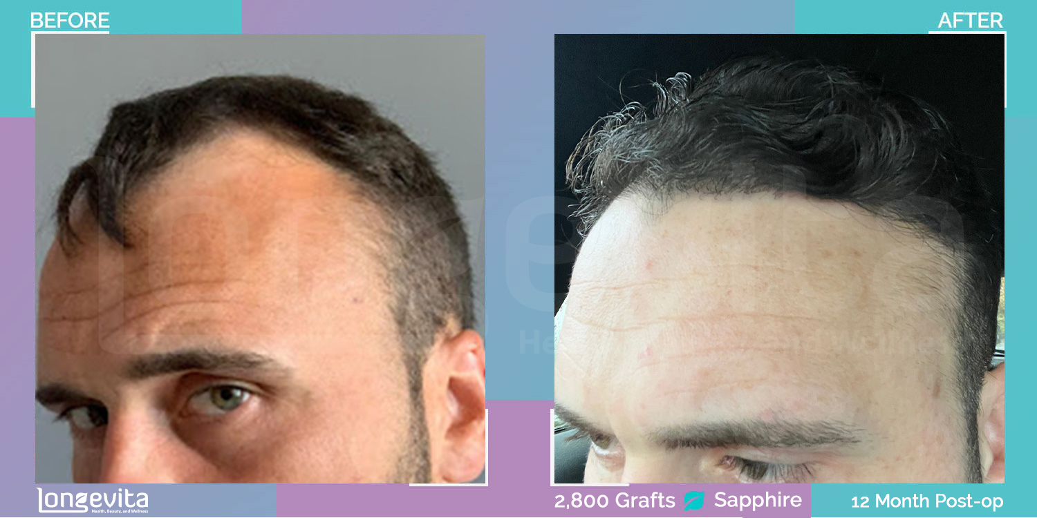 SAPPHIRE hair transplant before and after, 2800 grafts, 1 zone covered, 30s male patient