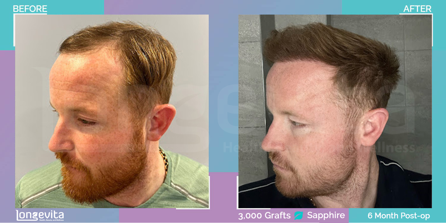 SAPPHIRE hair transplant before and after, 3000 grafts, 2 zones covered