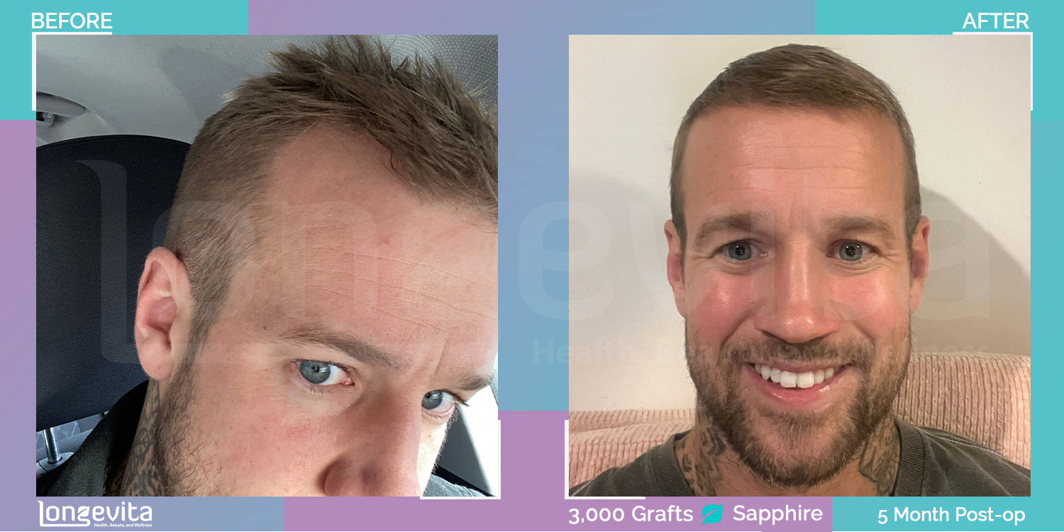 SAPPHIRE hair transplant before and after, 3000 grafts, 1 zone covered, 30s male patient