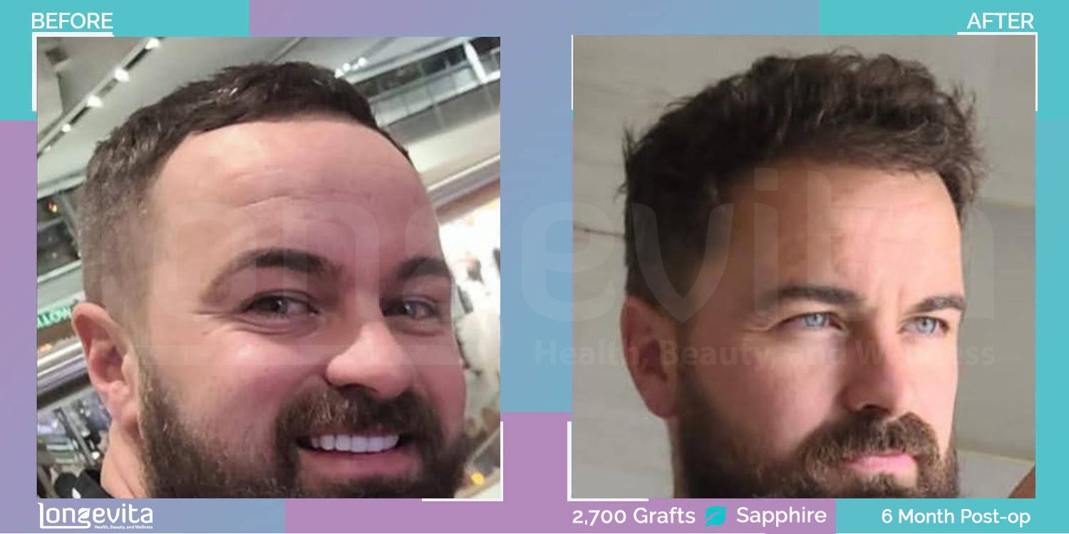 SAPPHIRE hair transplant before and after, 2700 grafts, 2 zones covered, 30s male patient