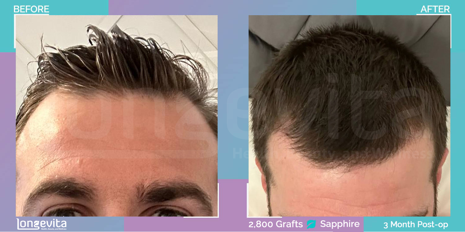 SAPPHIRE hair transplant before and after, 2800 grafts, 1 zone covered, 30s male patient