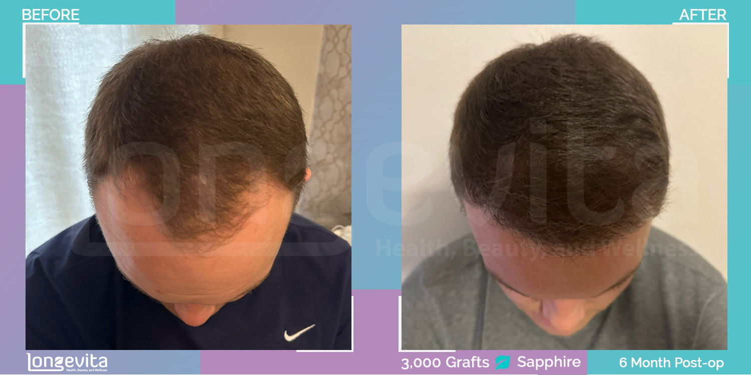 SAPPHIRE hair transplant before and after, 3000 grafts, 2 zones covered, 30s male patient