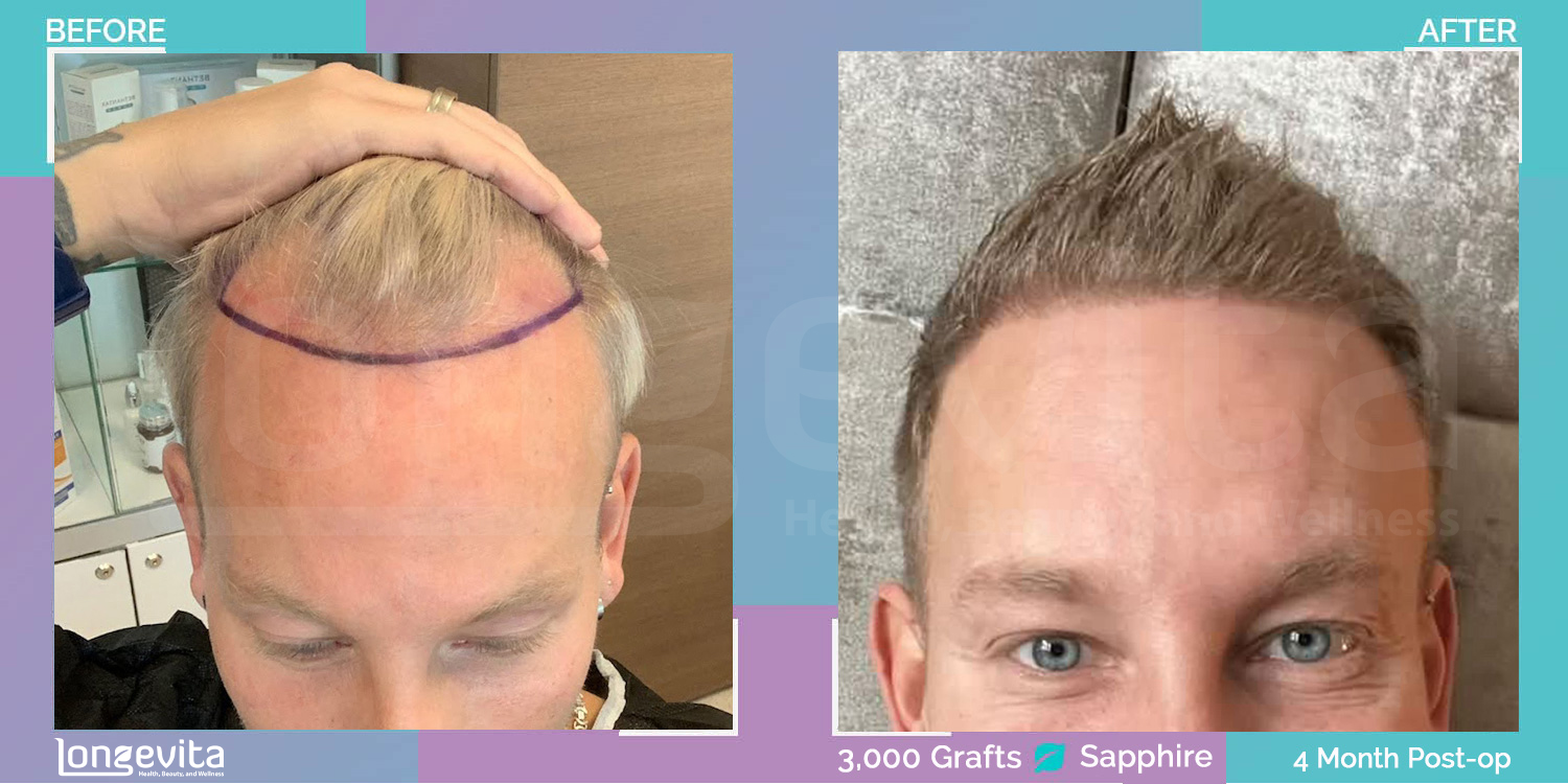 SAPPHIRE hair transplant before and after, 3000 grafts, 1 zone covered, 30s male patient