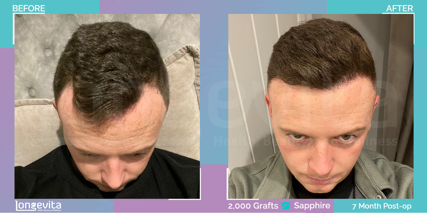 SAPPHIRE hair transplant before and after, 2000 grafts, 1 zone covered, 20s male patient