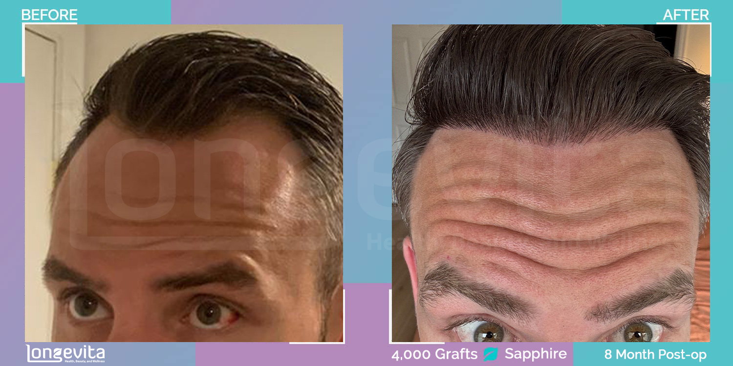 SAPPHIRE hair transplant before and after, 4000 grafts, 3 zones covered, 30s male patient