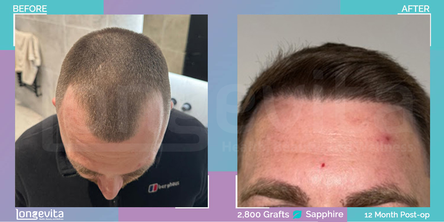 SAPPHIRE hair transplant before and after, 2800 grafts, 1 zone covered, 30s male patient