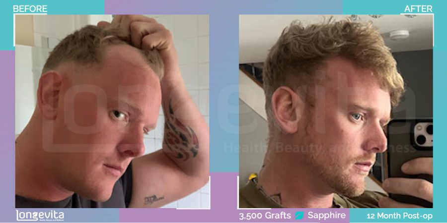 SAPPHIRE hair transplant before and after, 3500 grafts, 1 zone covered, 30s male patient