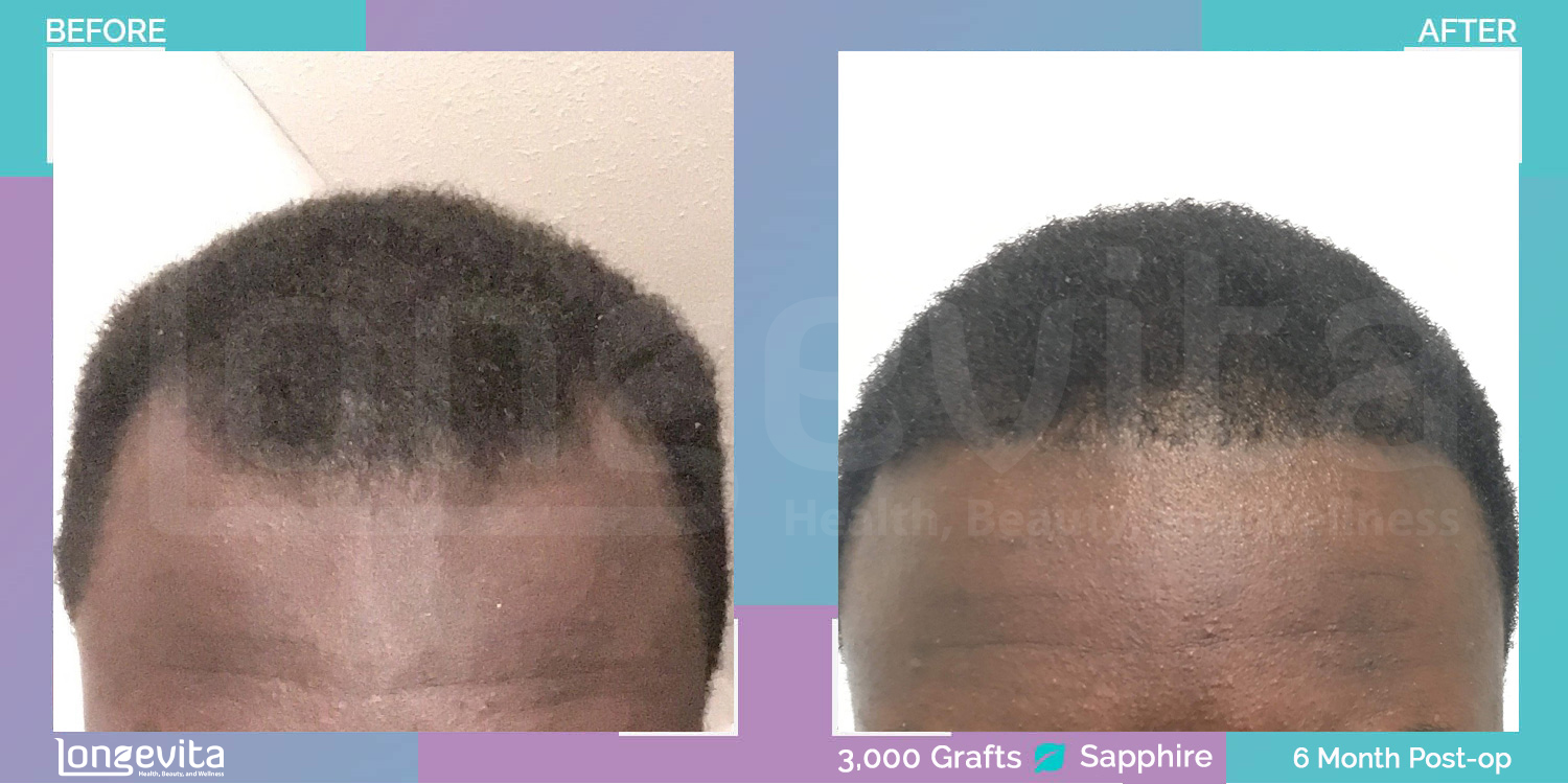 SAPPHIRE hair transplant before and after, 3000 grafts, 3 zones covered, 20s male patient