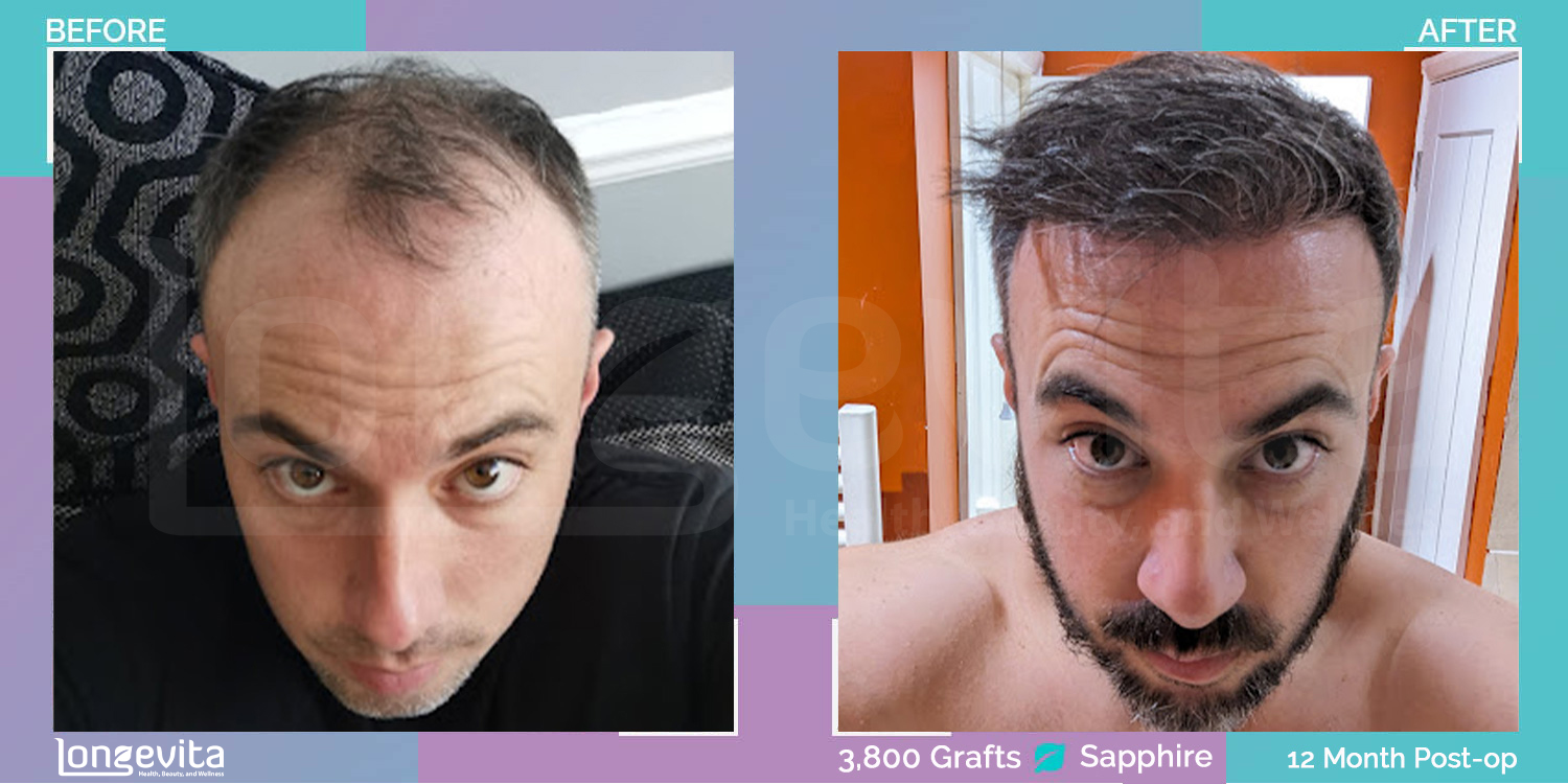 SAPPHIRE hair transplant before and after, 3800 grafts, 4 zones covered, 30s male patient