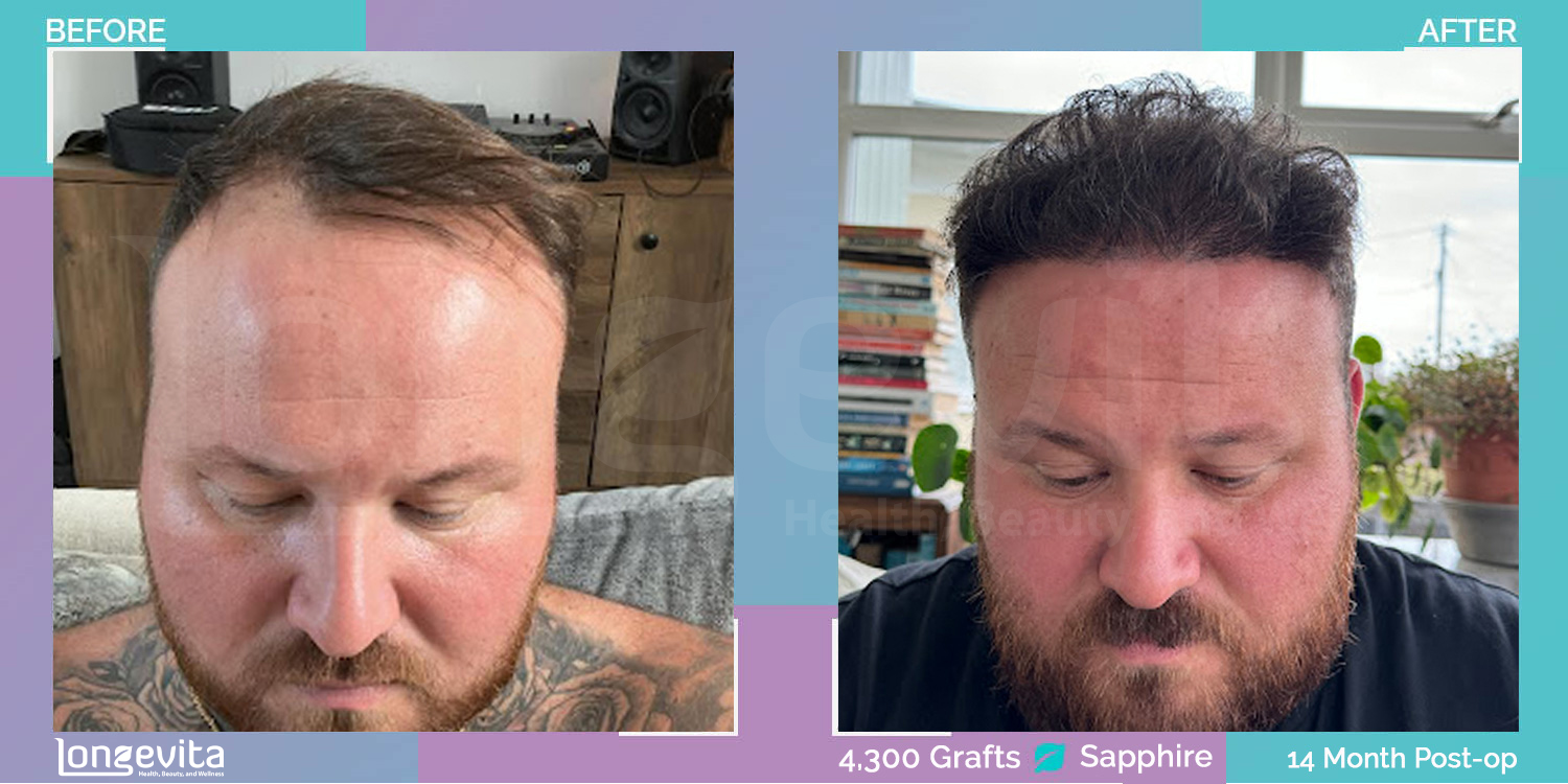SAPPHIRE hair transplant before and after, 4300 grafts, 3 zones covered, 30s male patient