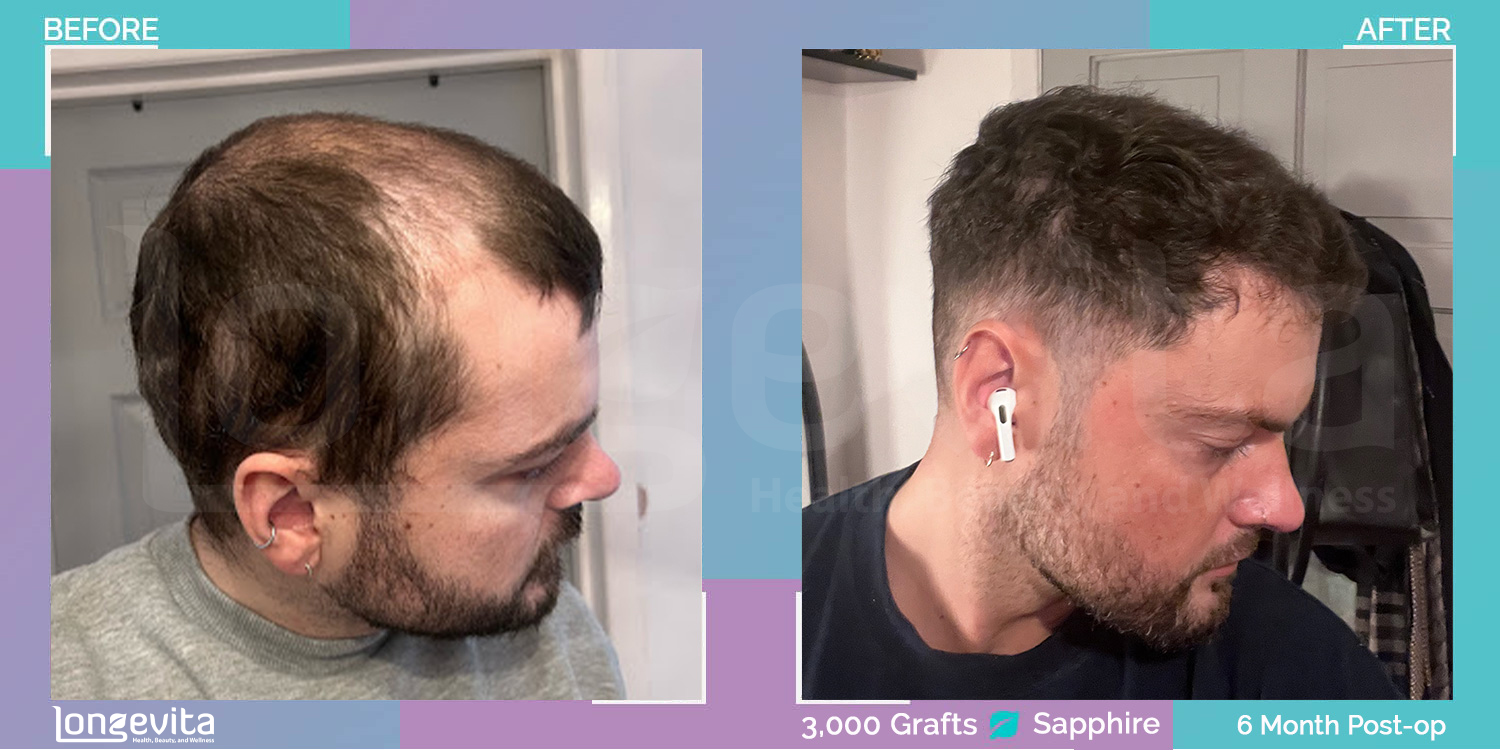 SAPPHIRE hair transplant before and after, 3000 grafts, 3 zones covered, 20s male patient