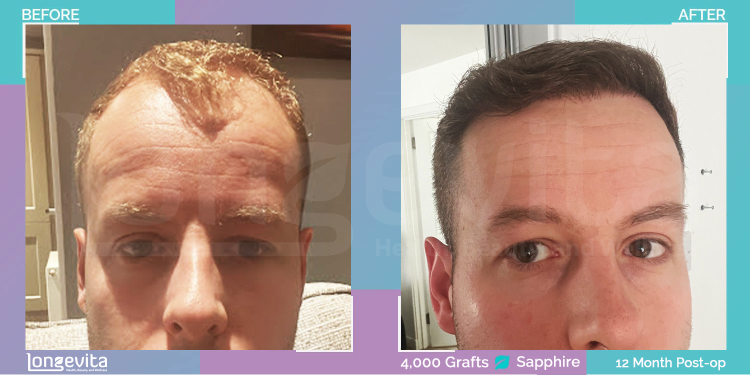 SAPPHIRE hair transplant before and after, 4000 grafts, 3 zones covered, 20s male patient