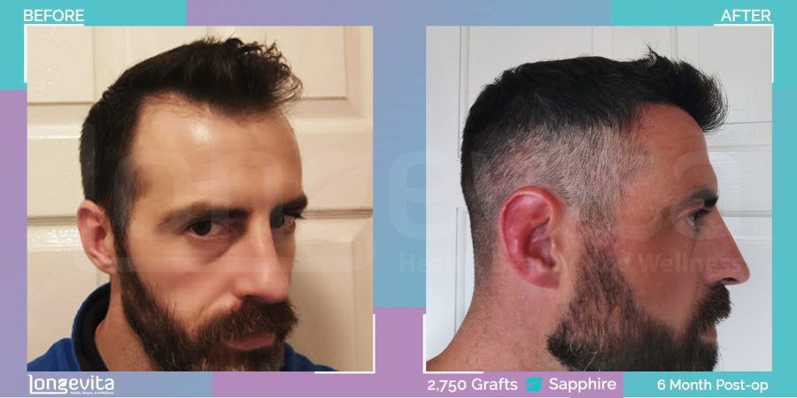 SAPPHIRE hair transplant before and after, 2750 grafts, 1 zone covered, 30s male patient