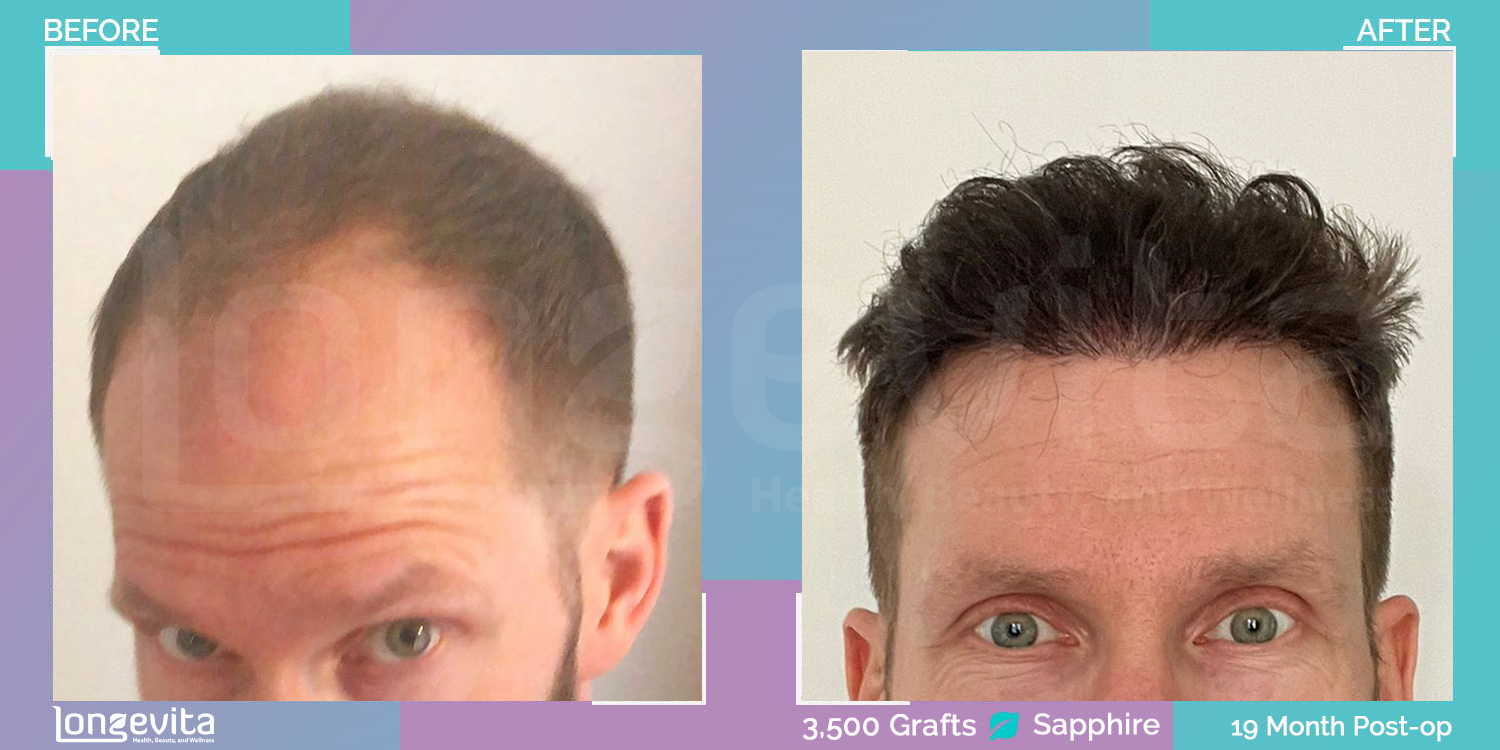 SAPPHIRE hair transplant before and after, 3500 grafts, 5 zones covered, 30s male patient