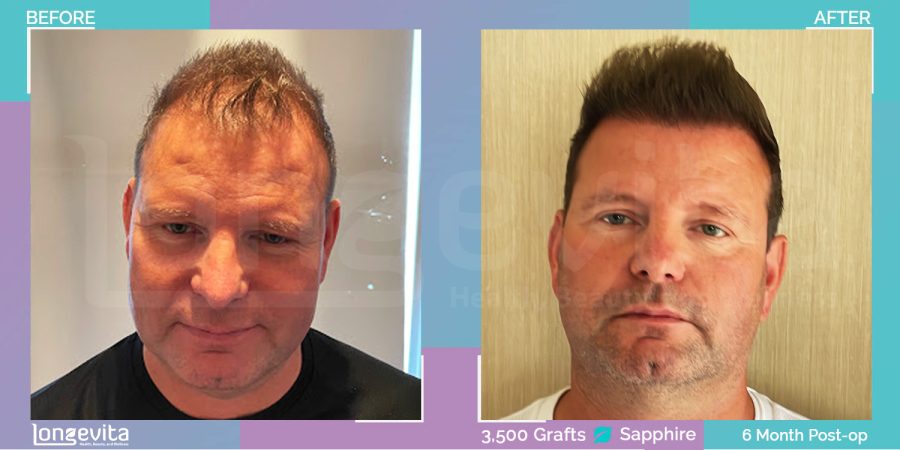 SAPPHIRE hair transplant before and after, 3500 grafts, 2 zones covered, 40s male patient