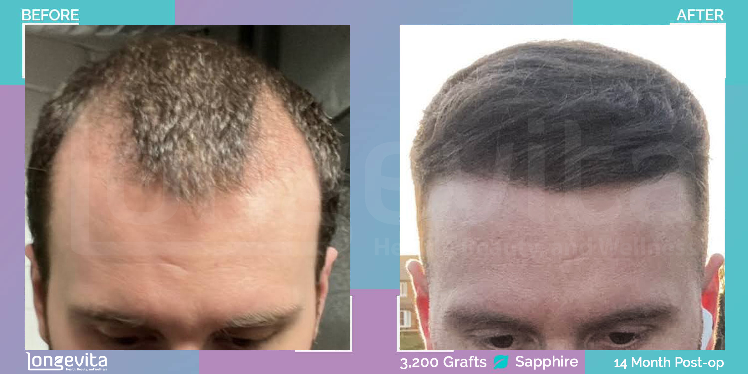 SAPPHIRE hair transplant before and after, 3200 grafts, 2 zones covered, 30s male patient