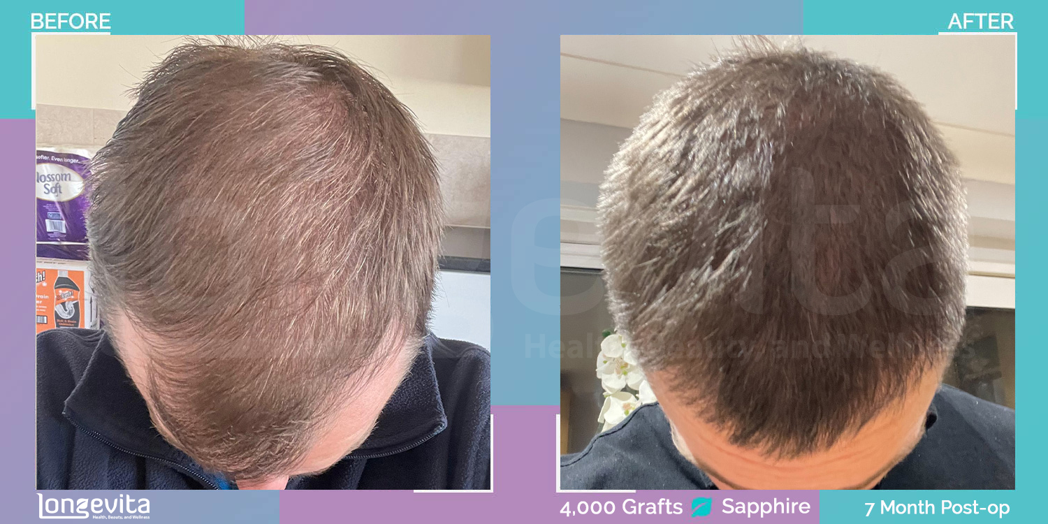 SAPPHIRE hair transplant before and after, 4000 grafts, 4 zones covered, 30s male patient
