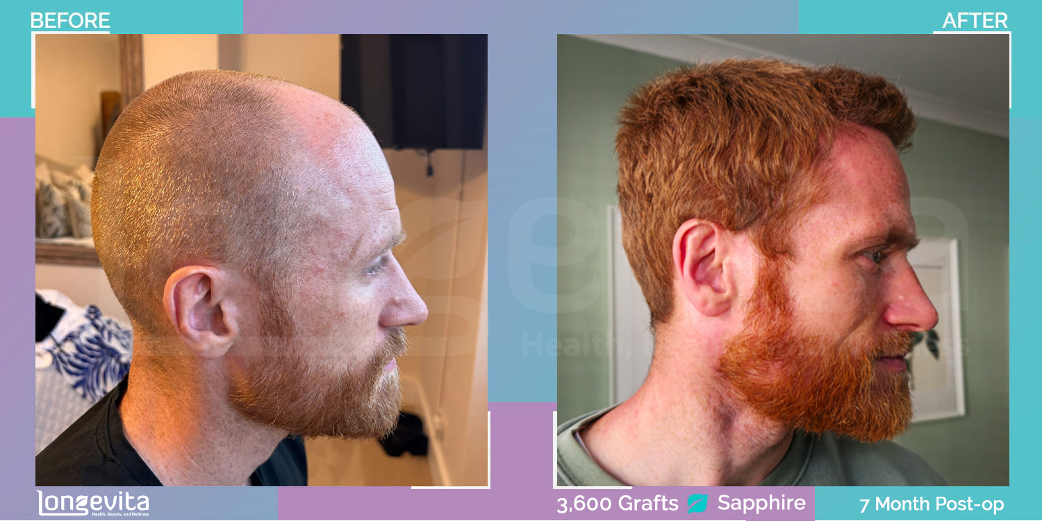 SAPPHIRE hair transplant before and after, 3600 grafts, 4 zones covered, 30s male patient